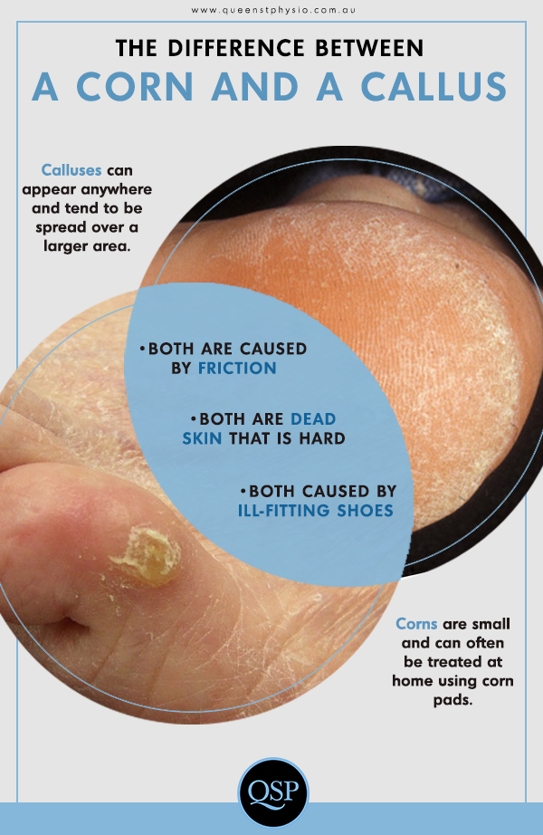 Corn or Callus: How to Tell the Difference - Queen St Physio
