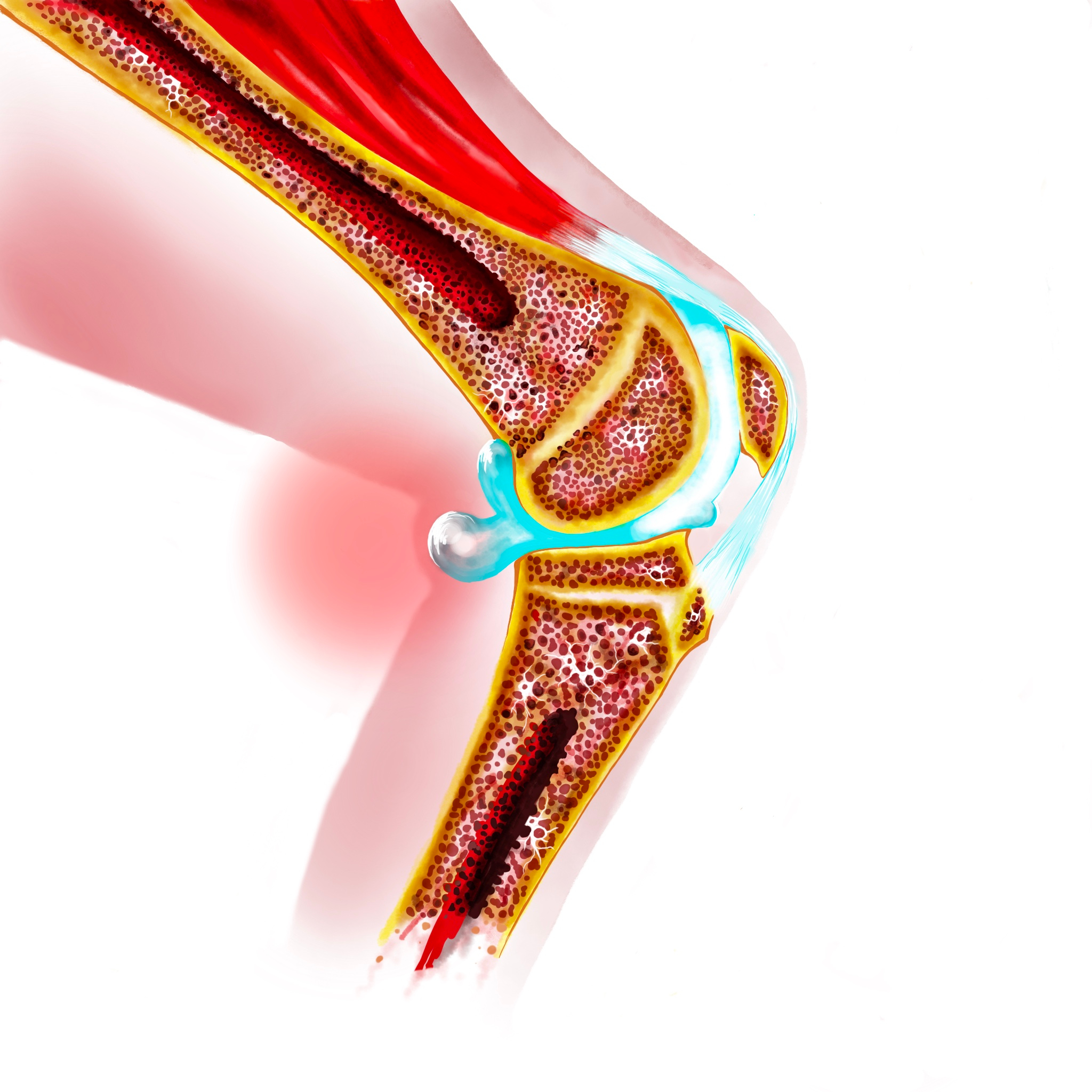 This image has an empty alt attribute; its file name is bakers-cyst-pic.jpg